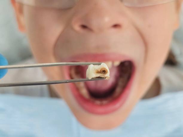 Best Emergency Broken Tooth Repair in Ashland, VA